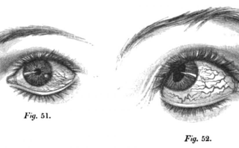 Eye eye