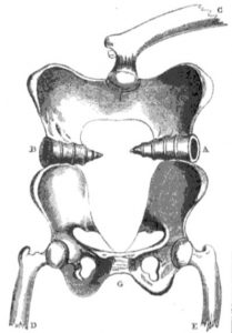double pelvis