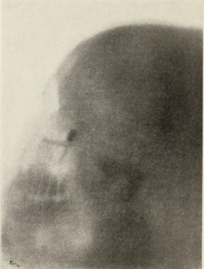 X-ray of patient's skull